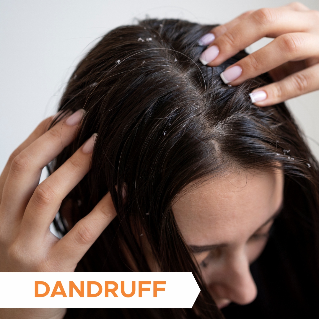 Anti Dandruff