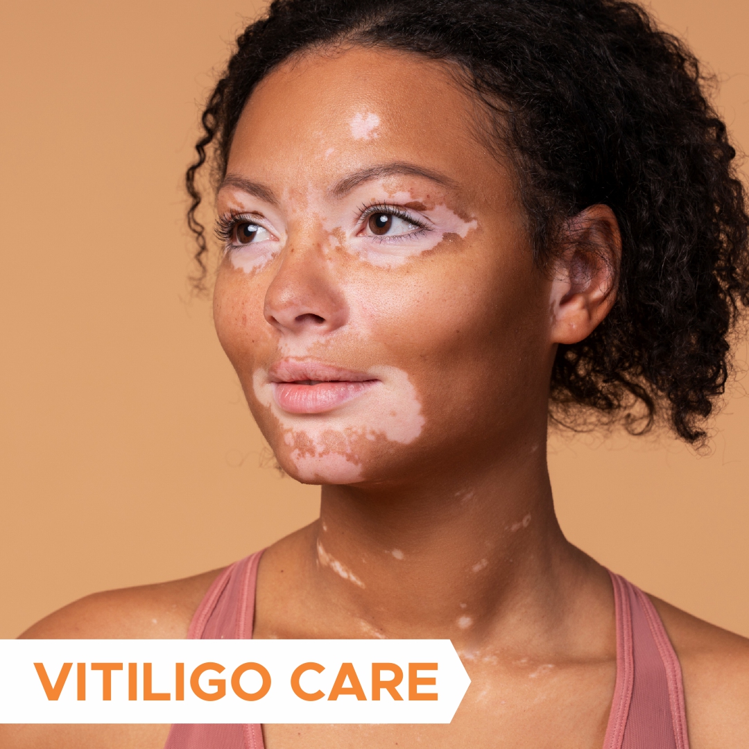 Vitiligo Care